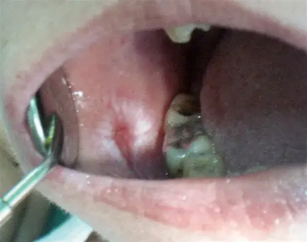 Liszaj w jamie ustnej objawy: poznaj niebezpieczne sygnały zdrowotne