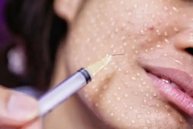 Zabieg z użyciem igły, aplikującej stymulatory tkankowe w punkty na skórze twarzy, która jest pokryta kropelkami.