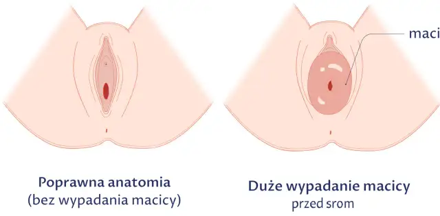 Obniżona macica po porodzie: 7 objawów, które musisz znać