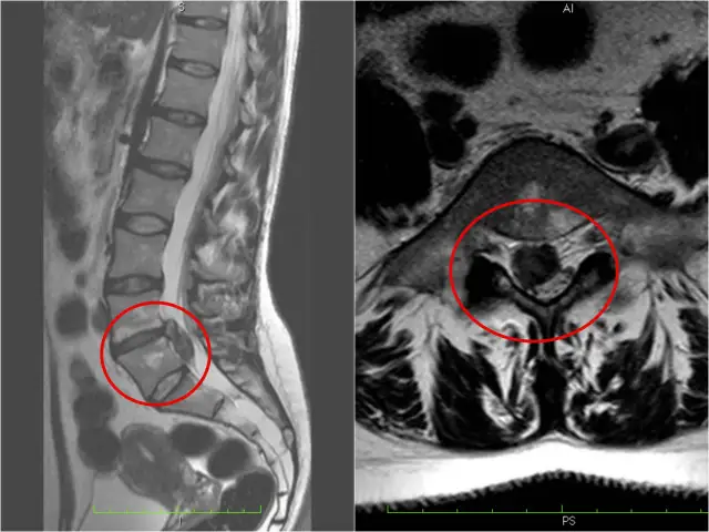 Wypuklina a przepuklina: kluczowe różnice i metody leczenia