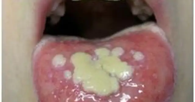 Ból i afty w ustach? Poznaj objawy zapalenia jamy ustnej i leczenie