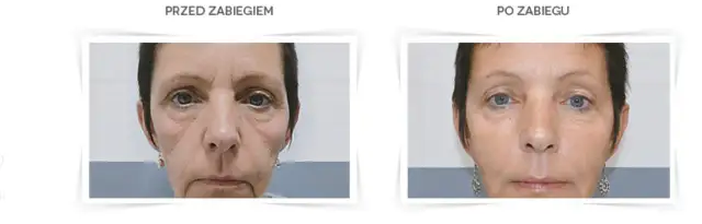 Po jakim czasie widać efekty kwasu hialuronowego? Sprawdź, zanim zdecydujesz