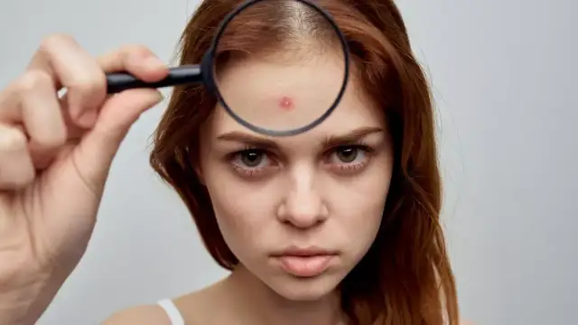 Pryszcze na czole: Skuteczne sposoby, pielęgnacja i leczenie