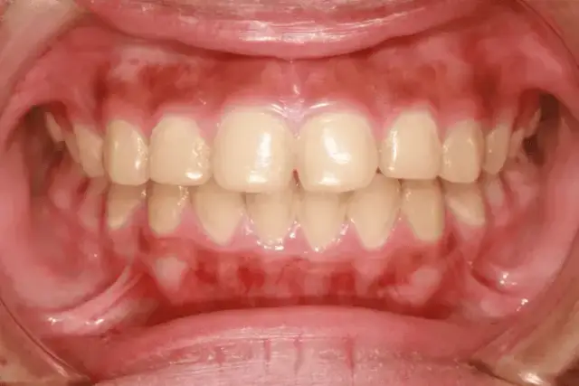 Jak wyglądają zdrowe dziąsła? Oto cechy, które musisz znać