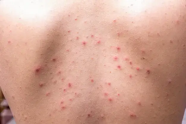 Skuteczne sposoby na pryszcze na plecach – jak się pozbyć problemu