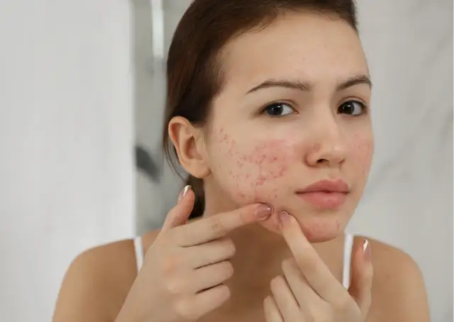 Czerwone plamy po pryszczach? Kompletny przewodnik do gładkiej cery