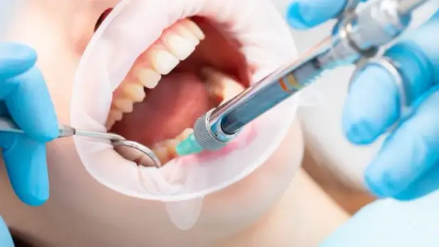 Znieczulenie u dentysty w ciąży: Czy jest bezpieczne? Poradnik