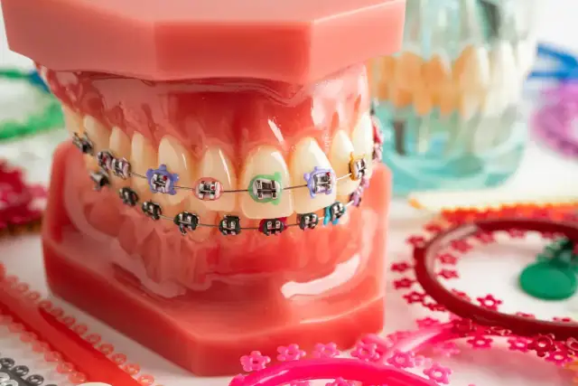 Aparat na zęby dla dzieci: Od kiedy? Wiek, koszty, refundacja NFZ