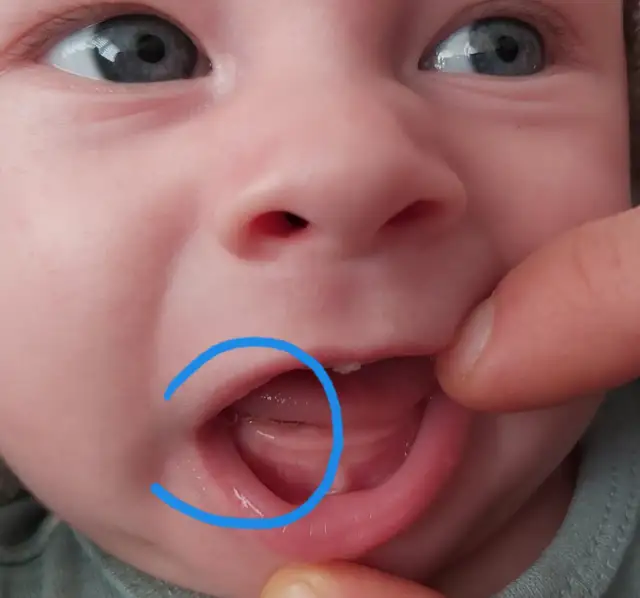 Jak wyglądają dziąsła przy ząbkowaniu – zdjęcia i objawy, które musisz znać