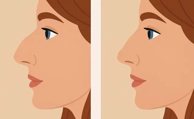 Czy kwas hialuronowy może się przemieszczyć? Oto co musisz wiedzieć