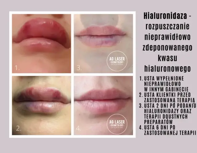 Niezadowolenie po kwasie? Jak przyspieszyć wchłanianie i hialuronidaza