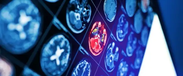 Co powoduje udar niedokrwienny? Poznaj niebezpieczne przyczyny i ryzyko