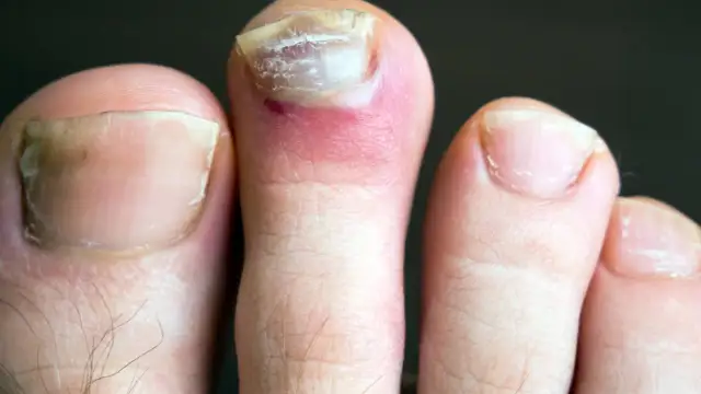 Wrastający paznokieć – jaki lekarz pomoże w skutecznym leczeniu?