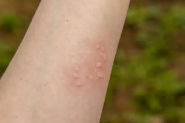 Alergia na ryby objawy - jak je rozpoznać i uniknąć zagrożeń