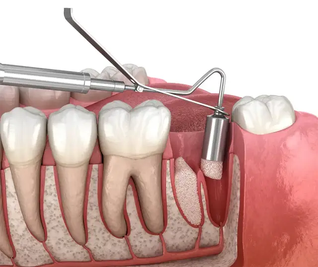 Higiena po ekstrakcji zęba: Bezpieczny przewodnik krok po kroku