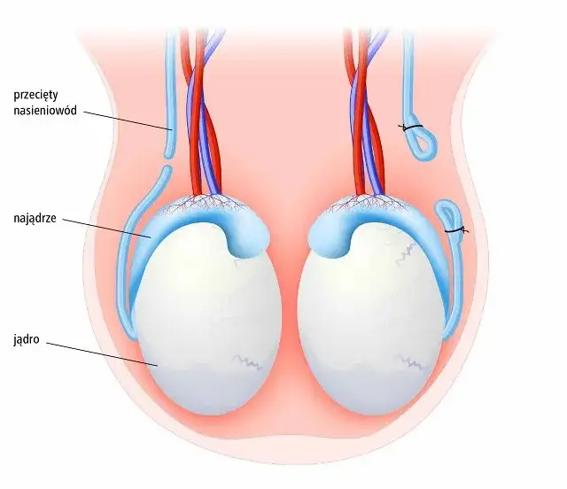 Czy wazektomia to grzech? Zrozum moralne konsekwencje decyzji
