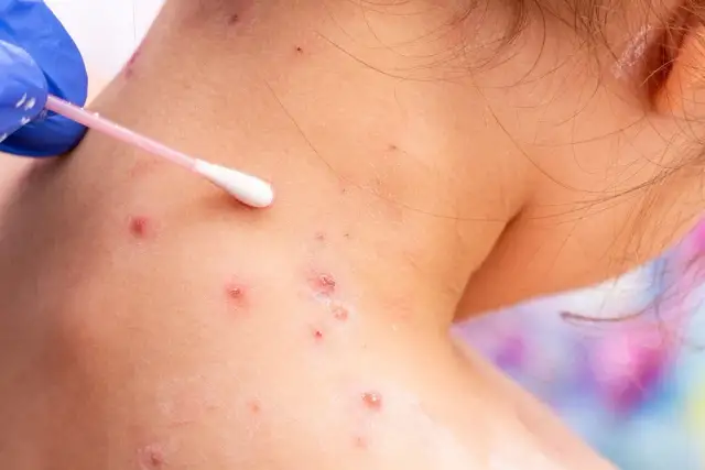 Ospa wietrzna: kiedy do lekarza, aby uniknąć poważnych komplikacji