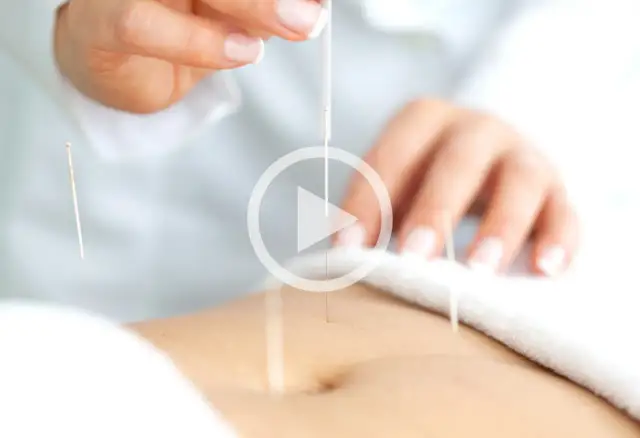 Akupunktura na płodność: Jak zwiększyć szanse na ciążę?