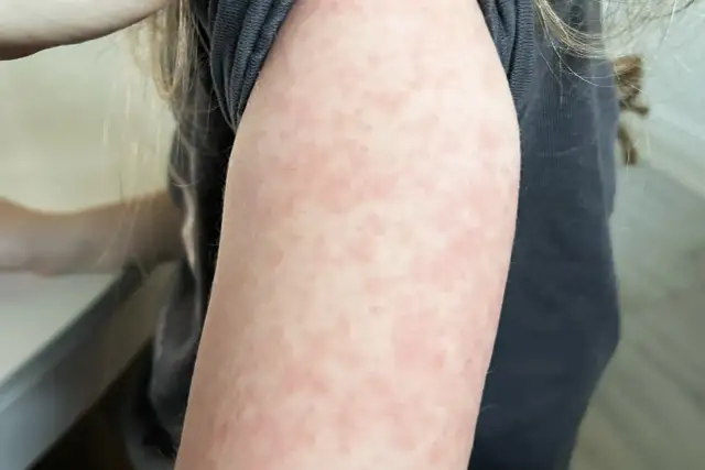 Rumień zakaźny kiedy do przedszkola: ważne informacje o zakaźności i powrocie