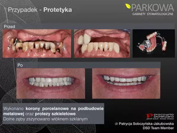 Szynowanie zębów: Na jak długo? Od urazu po paradontozę