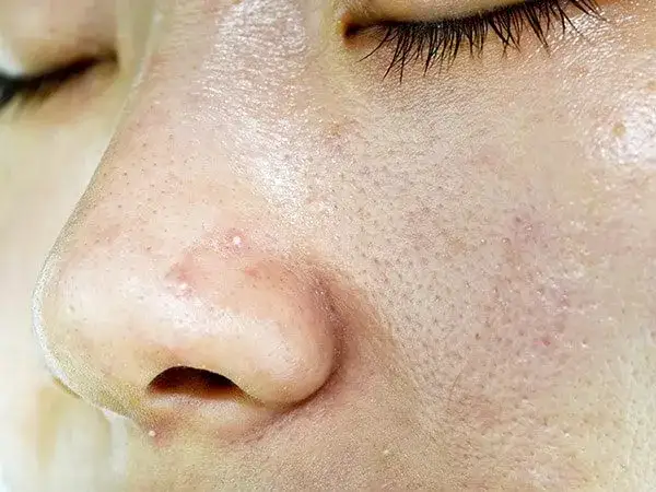 Fettige Gesichtshaut: Ursachen, Pflege und Tipps für klare Haut