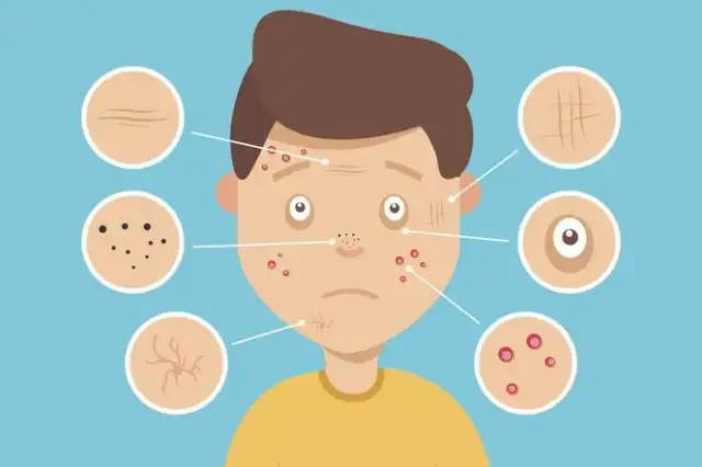 Skuteczne domowe sposoby na pryszcze, które naprawdę działają