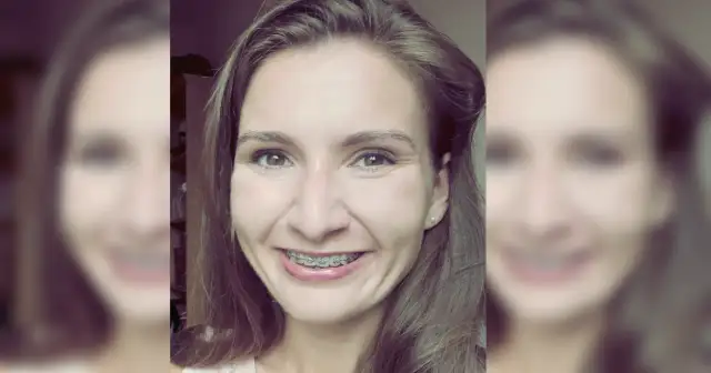 Kiedy trzeba nosić aparat na zęby? Zobacz, co musisz wiedzieć