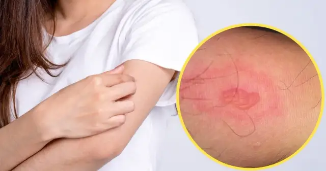 Ugryzienie pająka co robić: skuteczne sposoby na złagodzenie objawów