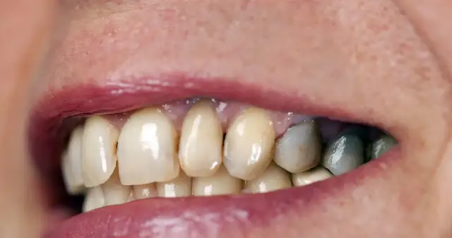 Czy piwo barwi zęby? Sprawdź, jak uniknąć przebarwień!