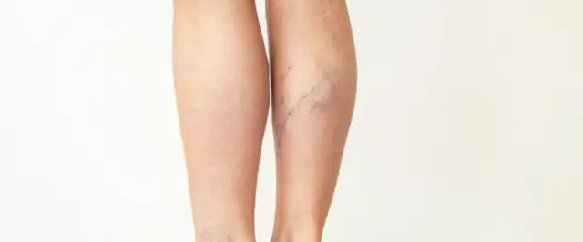 Zapalenie żył objawy: Jak rozpoznać i uniknąć poważnych problemów