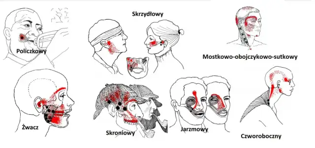 Ilustracje pokazują punkty bólu związane ze stawem skroniowo-żuchwowym. Różne obszary głowy i szyi zaznaczone czerwonymi kropkami wskazują potencjalne źródła bólu.