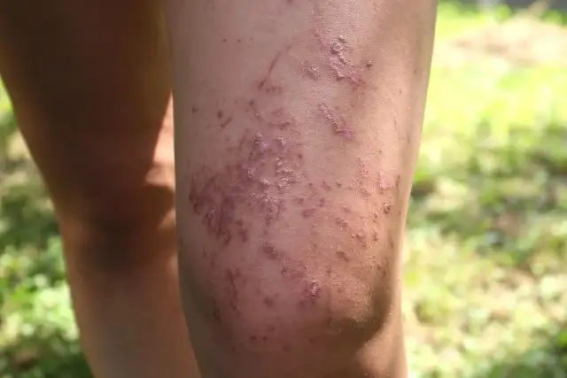 Mały barszcz sosnowskiego: Jak wyglądają poparzenia?