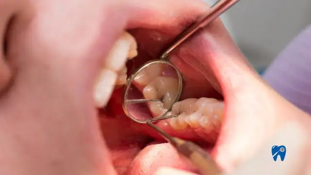 Dziura w zębie? Jak zabezpieczyć ubytek do wizyty u dentysty