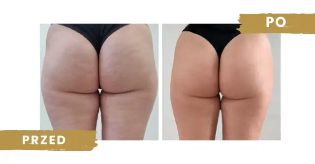 Endermologia: Jak działa, efekty, cena i wskazania poznaj wszystko