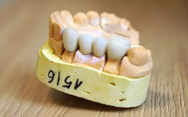 Koszt mostu protetycznego na 1 ząb: Dlaczego to 3 punkty? Ceny