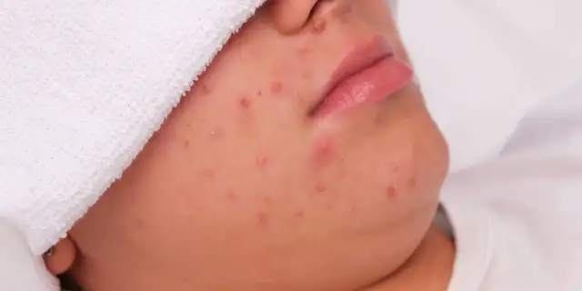 Twarz z licznymi podskórnymi pryszczami i zaczerwienieniami, przykryta białym ręcznikiem.