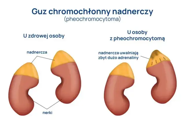 Guz chromochłonny objawy: jak rozpoznać niebezpieczne symptomy