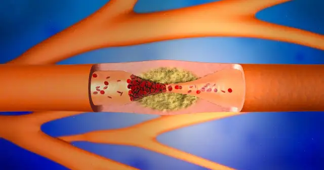 Przekrój naczynia krwionośnego z zakrzepem i płytkami krwi. D dimery jak wygląda badanie.