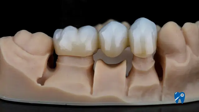 Gojenie dziąseł pod protezę: Ile trwa? Harmonogram i opieka