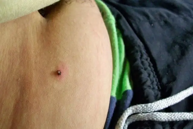 Kleszcz pod skórą: Czy to groźne? Objawy, KZM, rumień poradnik