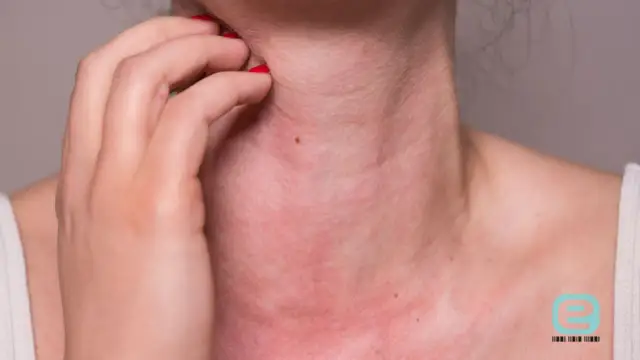 Alergia na nikiel w ustach: objawy, przyczyny i skuteczne leczenie