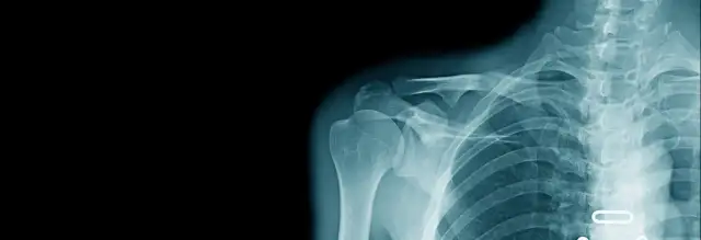 Złamanie nasady bliższej kości ramiennej - Od diagnozy do sprawności