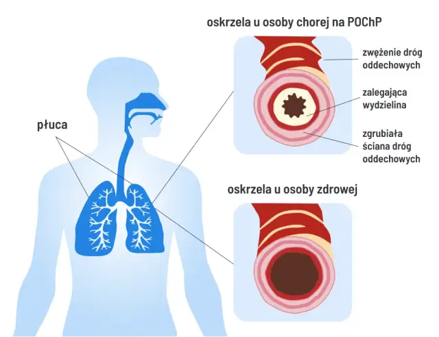 Czy POChP kwalifikuje do renty? Sprawdź, co musisz wiedzieć