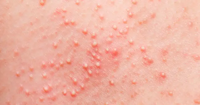 Skóra niemowlęcia pokryta drobnymi białymi krostkami, które mogą świadczyć o tym, że niemowlę się poci.