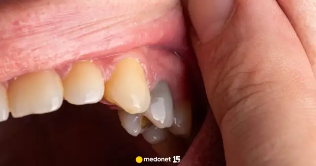 Martwy ząb boli? Poznaj przyczyny i skuteczne leczenie!