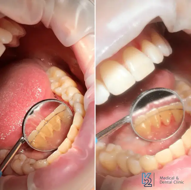 Usuwanie kamienia nazębnego: co działa, a co szkodzi?