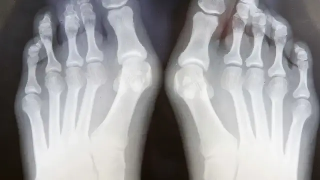 Skuteczne środki na haluksy w aptece, które przynoszą ulgę