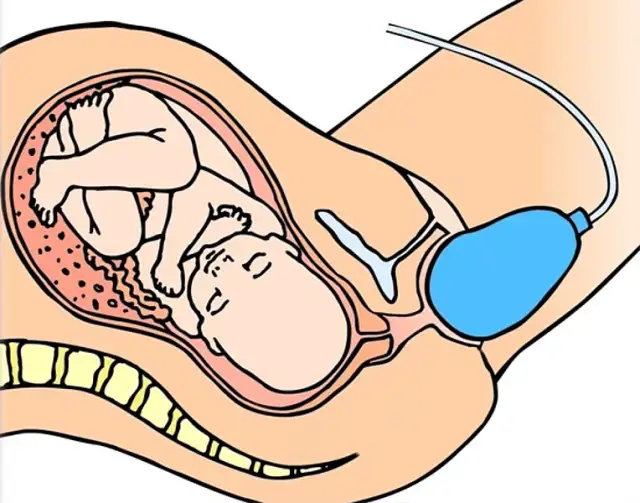 Jak włożyć coś do balonu bez ryzyka jego uszkodzenia?