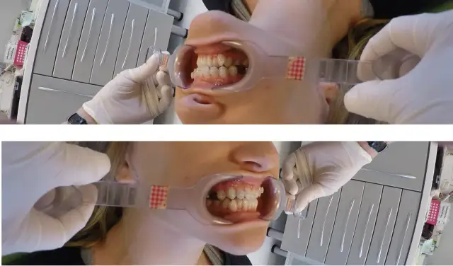 Jak bezpiecznie przekręcać aparat Hassa i uniknąć bólu podczas używania