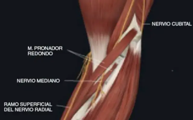 Edema muscular pronador redondo: ¿Por qué duele tu antebrazo?